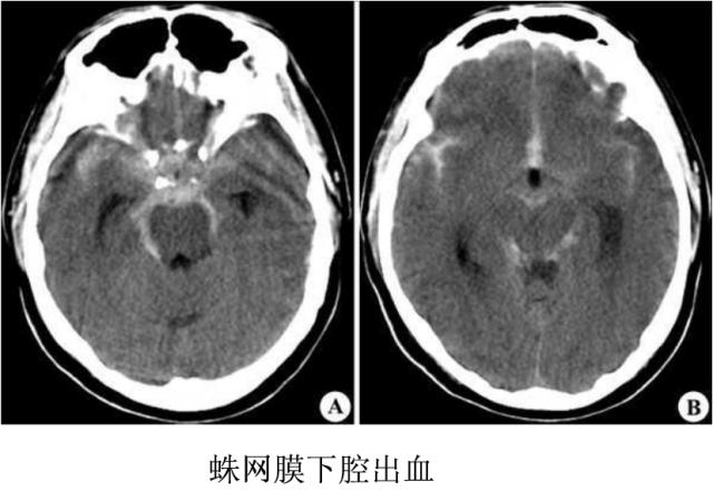 头颅ct解剖与常见出血梗死判读