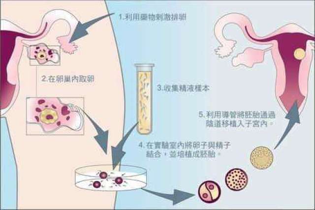 试管婴儿的流程它的具体流程是:"试管婴儿"是体外受精—胚胎移植技术