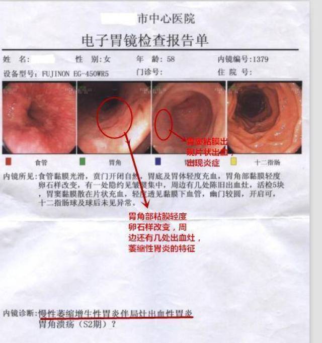 急性胃炎和慢性胃炎的病理分析!