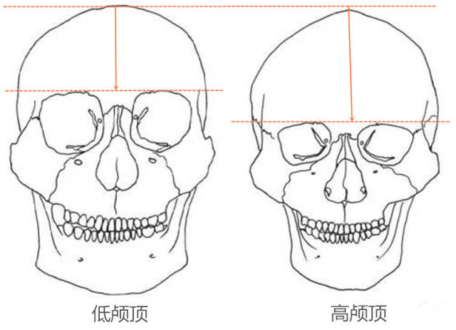 除了发际线的原因外,还有本身头颅骨的差异