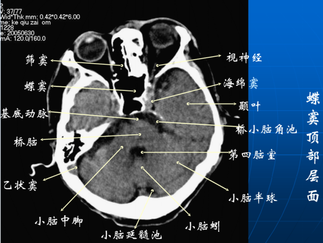 头颅ct解剖与常见出血梗死判读