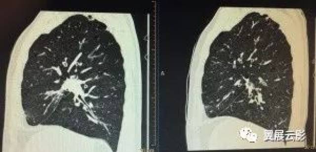 【病例】左肺上叶上舌段可见多个斑片状磨玻璃样密度增高,其内可见