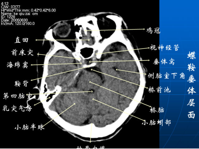 头颅ct解剖与常见出血梗死判读