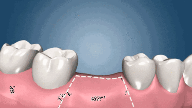 做种植牙有什么需要注意?种牙手术大揭秘