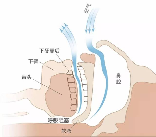 普通枕头秒变成止鼾枕,从此耳边无鼾声,一觉到天亮!