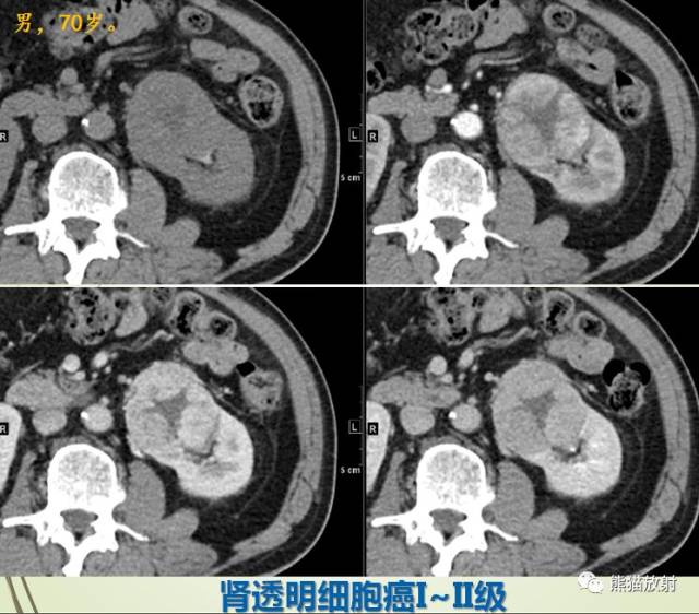 大多数嫌色细胞癌常无典型的"肾癌三联征"( 血尿,腰痛及肿块) ,多为