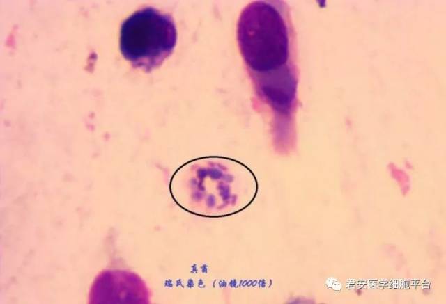 肺隐球菌感染病例分享