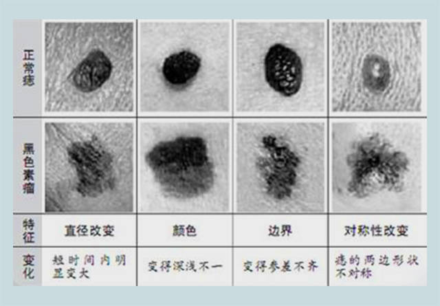 恶痣会癌变身上哪些痣会癌变做好这2点你的痣就不会癌变了