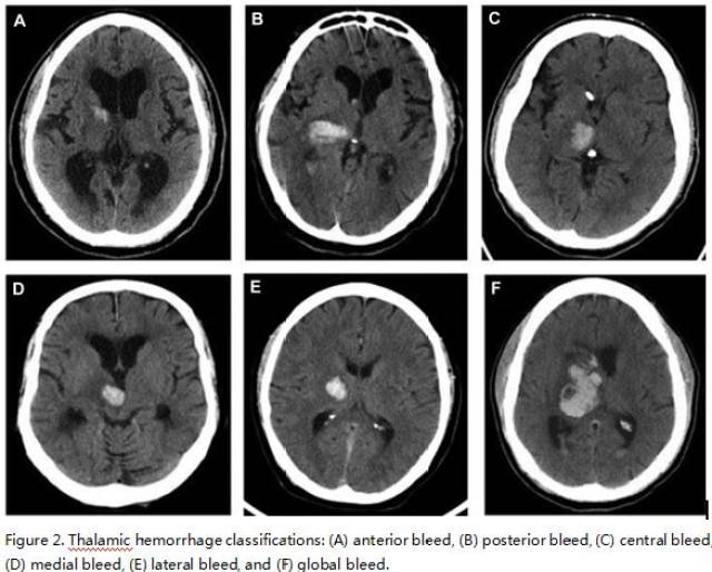 根据ct扫描轴位成像将丘脑出血分为6类,前,后,内侧,外侧,中央或全丘脑