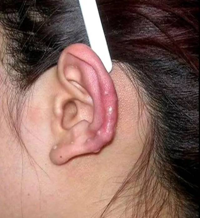 广州一女子因爱美打耳洞,竟导致耳朵畸形!