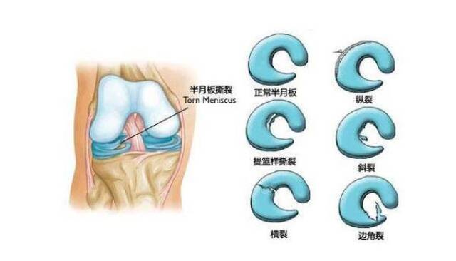 对于半月板撕裂损伤,目前大多数医生都主张早期关节镜下手术治疗