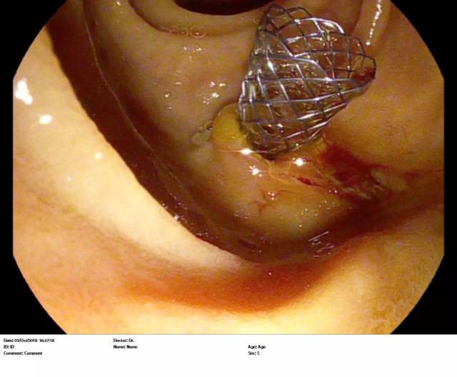【消化肿瘤科】胆管癌,小支架解决大问题