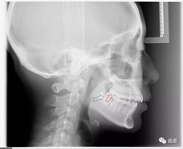 作为牙医,当你还在犹豫患者智齿该不该拔的时候,看这里!