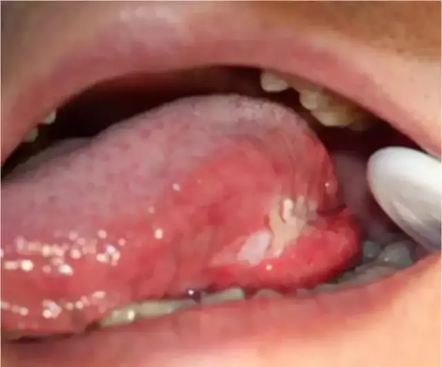 29岁小伙口腔溃疡2个月,一查竟是癌症!这些情况千万小心