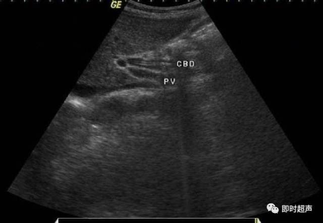 胆道蛔虫的超声诊断