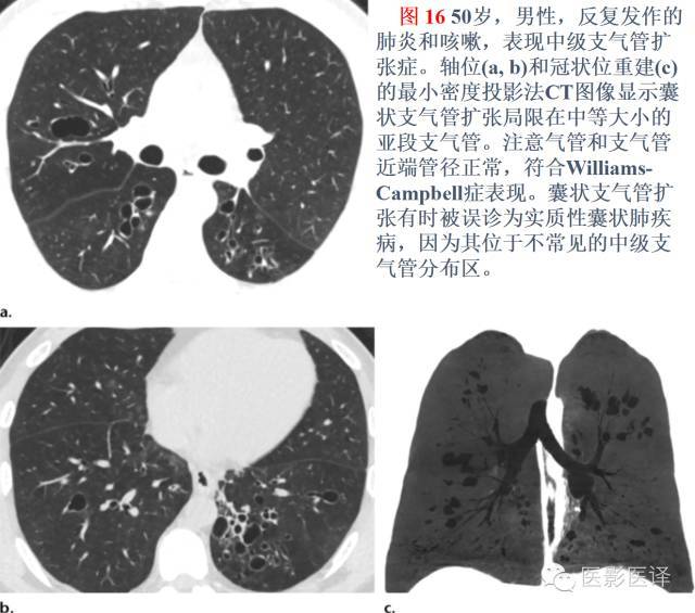 支气管扩张的机制,影像特征和病因分析