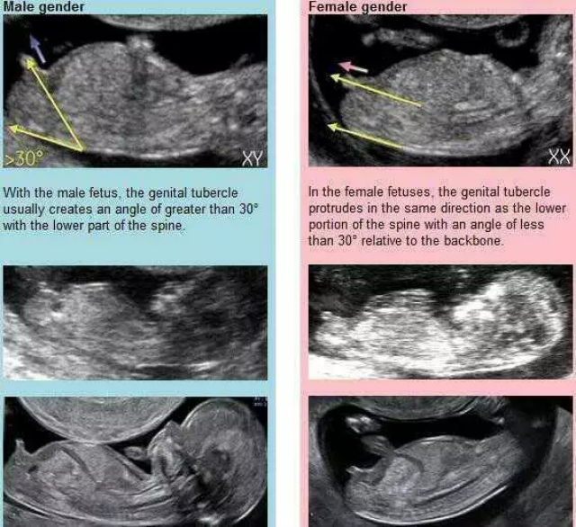 可以对照自己怀孕12周-14周后拍的b超单,如果是男宝的话,生殖部位和
