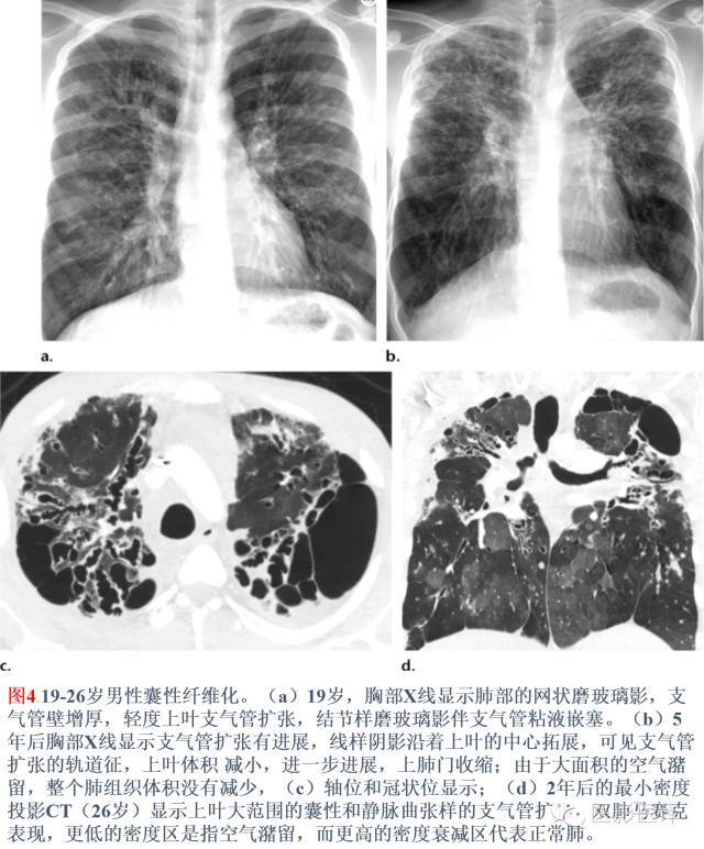 支气管扩张的机制,影像特征和病因分析