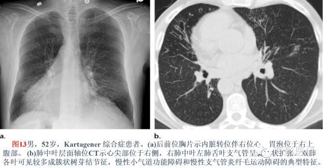 支气管扩张的机制,影像特征和病因分析