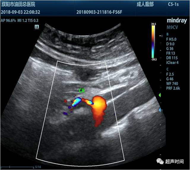 多年腹痛:超声发现病因竟然是一根血管