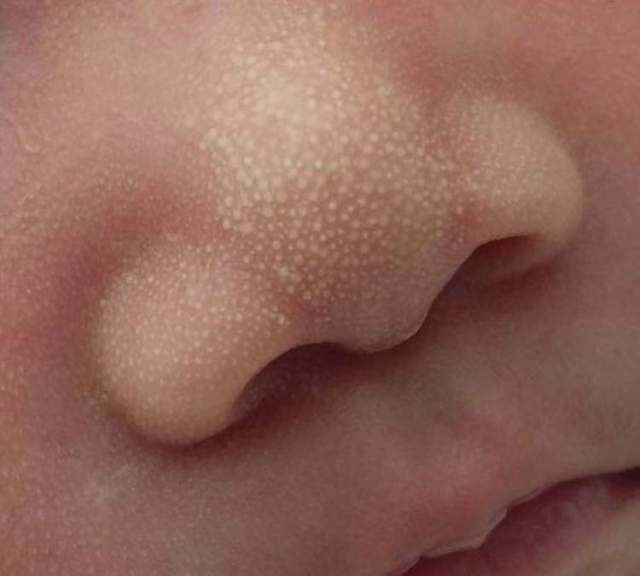 前几日有位新妈妈给家有好baby留言说自己的宝宝鼻子上有很多小白点