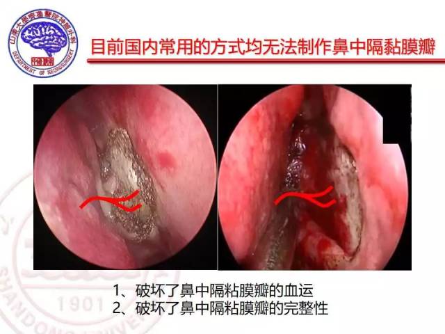 鼻黏膜收敛液为50 ml丁卡因 5 ml肾上腺素.