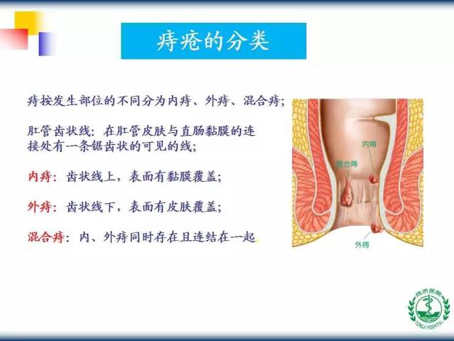 教学ppt | 内镜下内痔硬化治疗术(内含视频,推荐收藏!