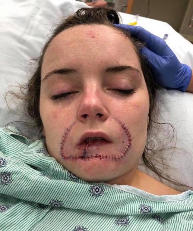 美国一名女生被前男友咬烂了嘴唇,因为他想在她身上留