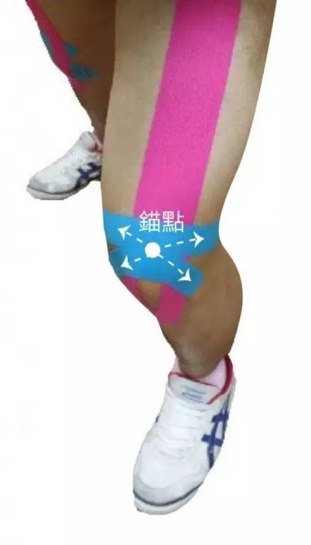 将y型的部分沿着膝盖髌骨两侧向下贴到小腿骨突点,几乎不给张力 step
