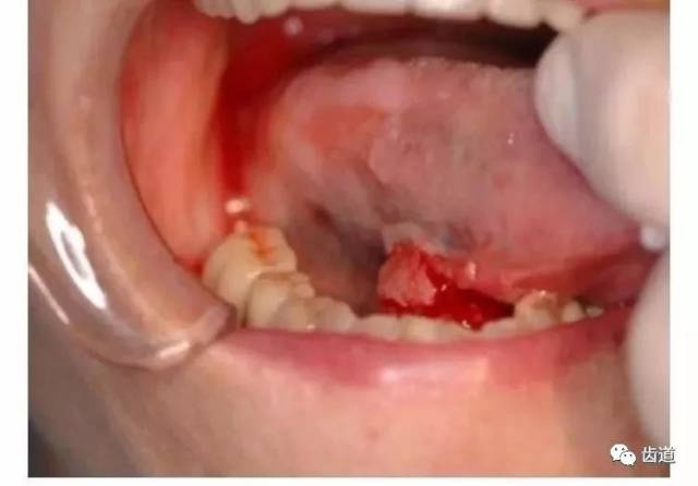 口腔内发现有肿瘤,肿胀或者肥大的部位