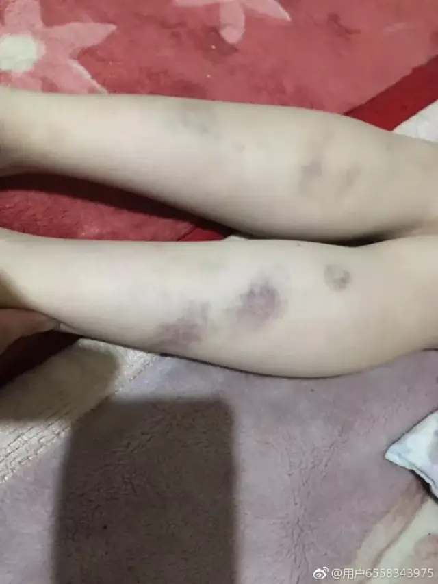 网曝青海互助一学生被体罚,全身多处淤青!