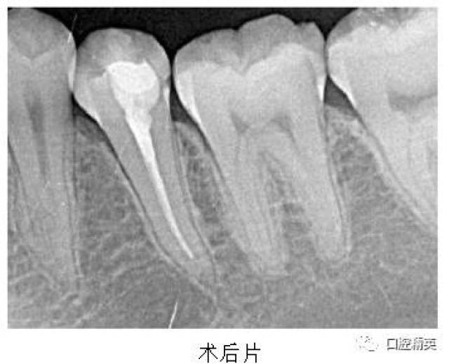 下5根管治疗后树脂充填1例