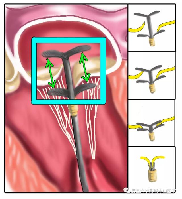 在跳动的心脏上完成超微创手术?我国自主研发二尖瓣器械获重大突破!