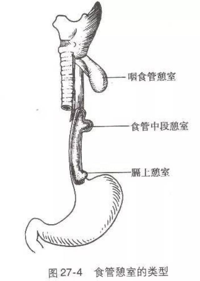 食管憩室