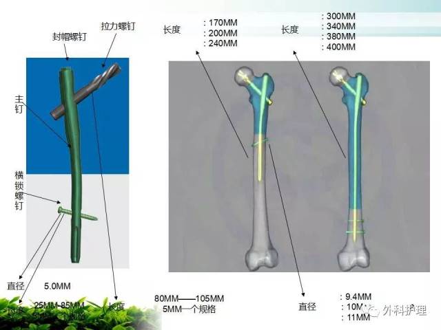 【ppt】股骨粗隆间骨折pfna的学习