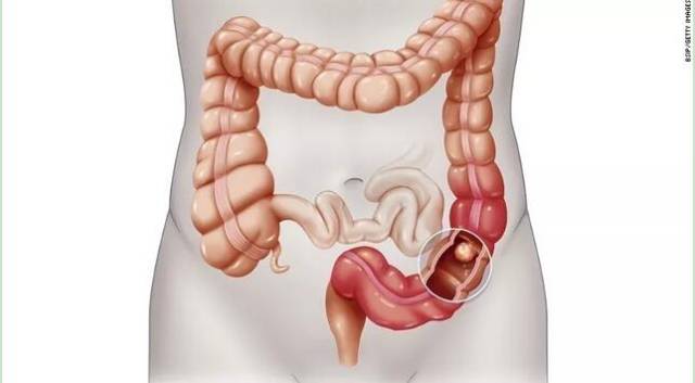 结肠癌治疗方法  人体的大肠和可以进一步分为结肠和直肠.