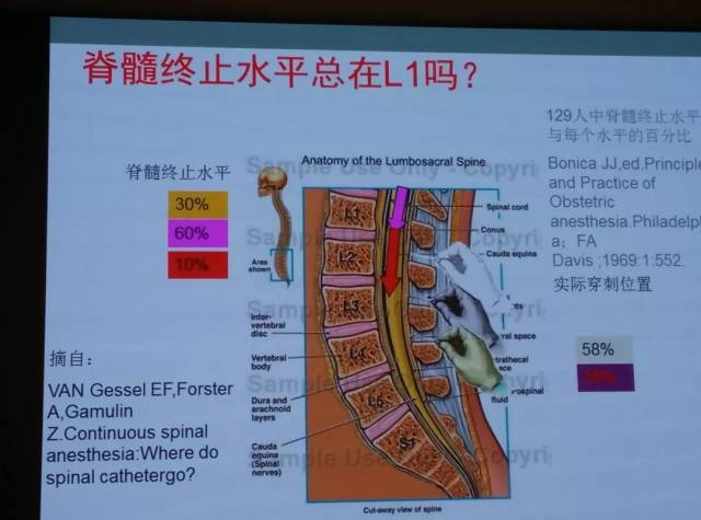 很多人在定位时常常摸到上侧髂嵴最高点,直接垂直地面,通过垂线与