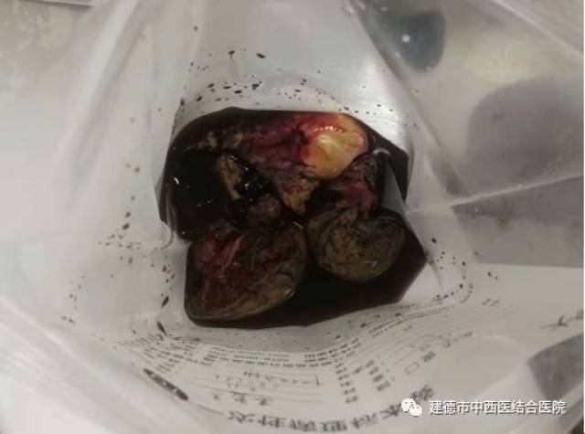 00,杨女士在腹腔镜下行左肝血管瘤切除术 腹腔引流术,手术顺利完成