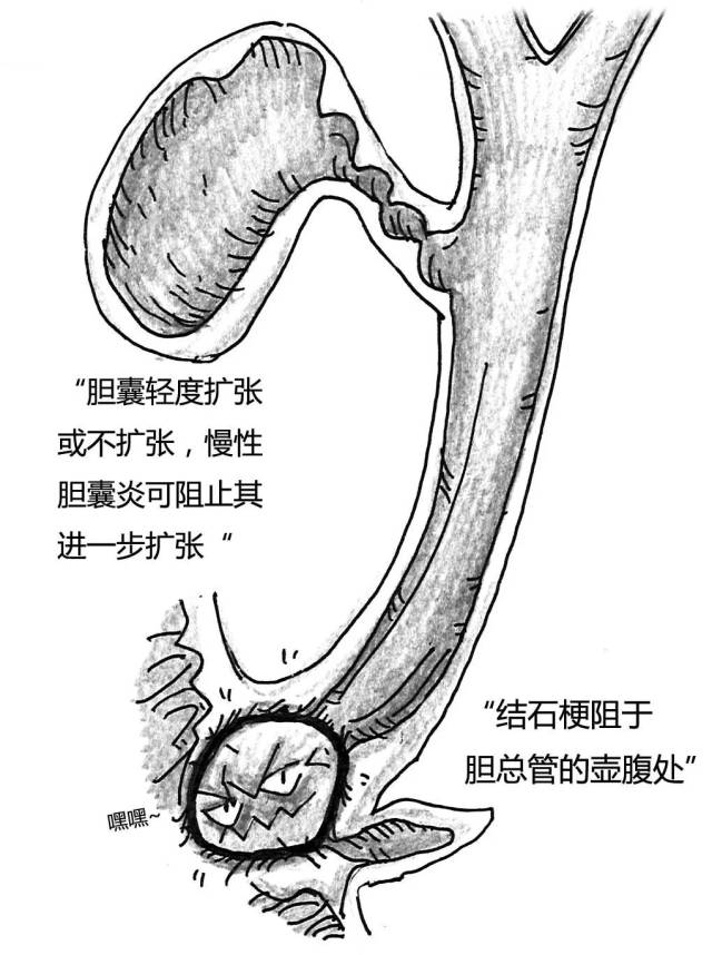 壶腹部结石同时阻塞胆管和胰管