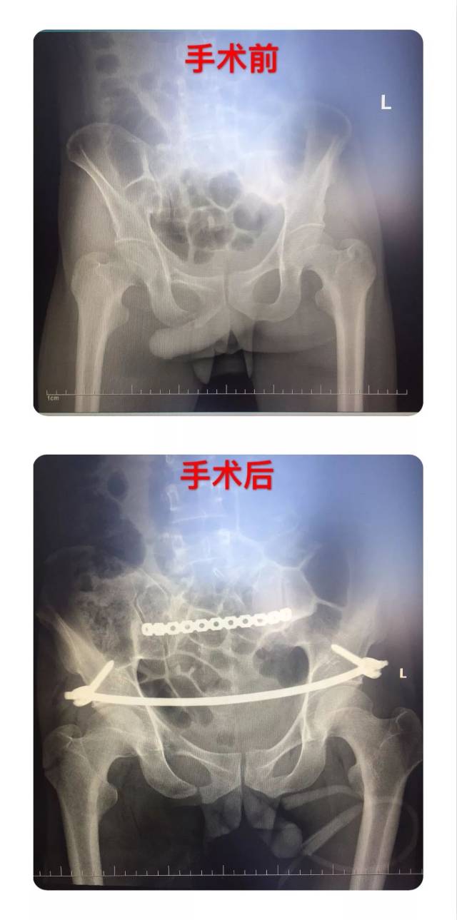 2cm切口下复位骨折骨盆——巴彦淖尔市医院创伤骨科自主完成首例骨盆