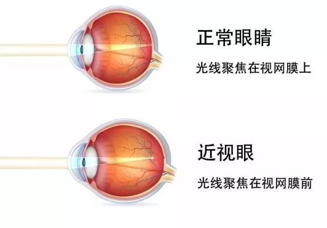 近视是在调节放松的状态下,平行光线经眼球屈光系统后聚焦在视网膜之