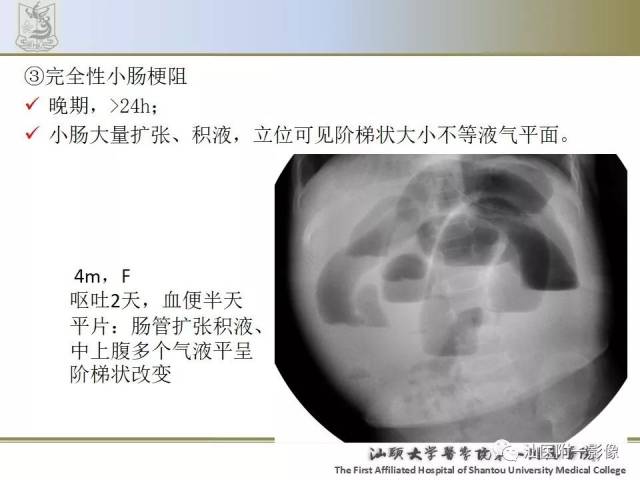 肠套叠影像学诊断