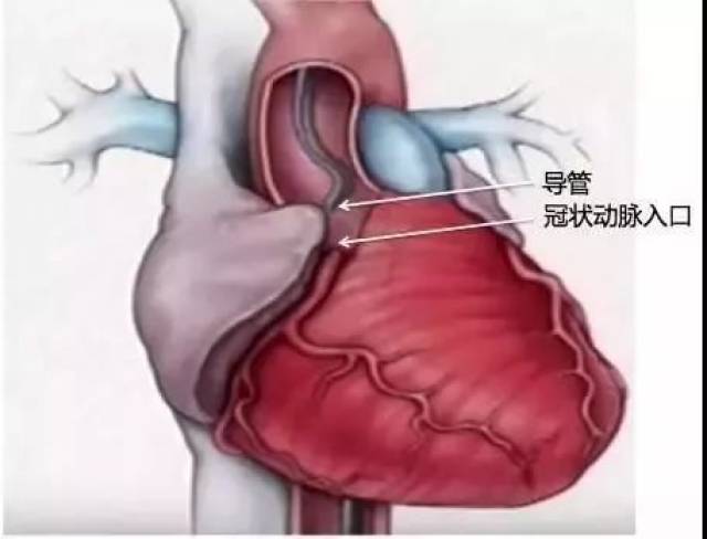 从动脉入口将一根导管慢慢放入,直至冠状动脉开口.