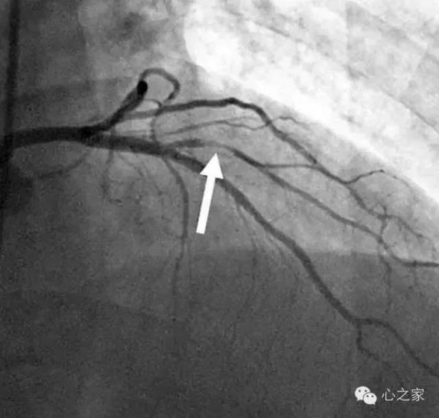 pci专场丨一分钟读懂:心脏血管哪里堵了?心脏支架怎么