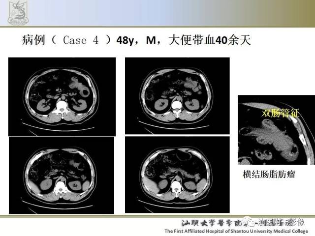 肠套叠影像学诊断