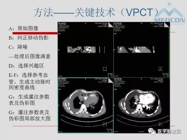 肺癌ct灌注成像临床应用及其机制 | 影像天地