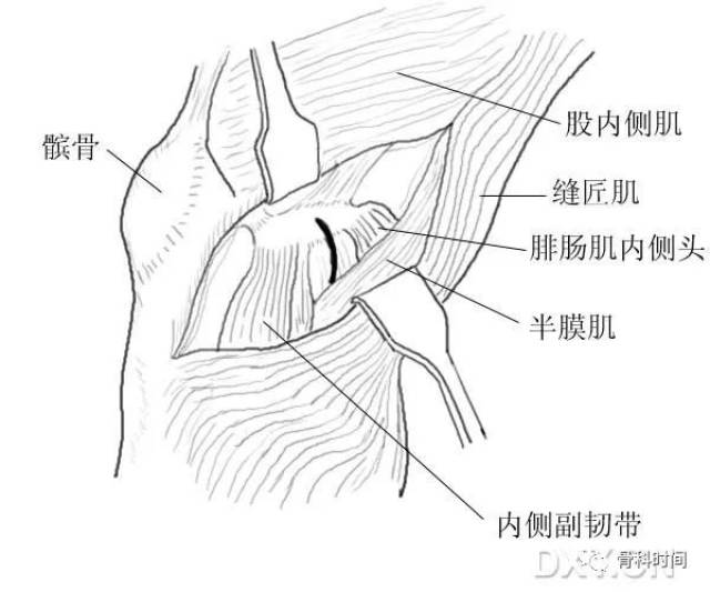 膝关节胫后游离体摘除术 屈膝位,自内收肌结节沿内侧副韧带走行作切口