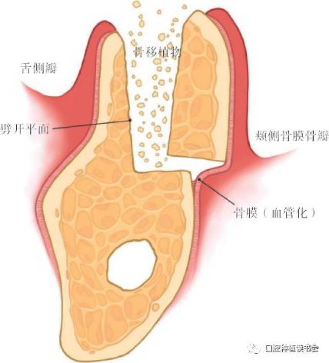 黄元丁教授|牙槽嵴骨劈开术的背景与适应症(1)