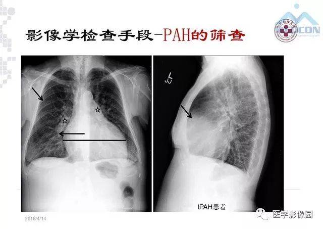 肺动脉高压放射影像学诊断与评价 | 影像天地