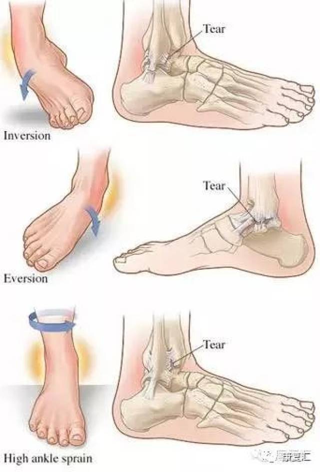 脚踝扭伤痛得很简单易学的康复方法99的人都不知道